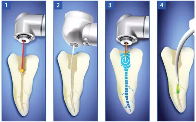 handpieces dental in endodontic application